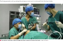 【海外発！Breaking News】5歳男児の喉からヒルを摘出　1年前から喉の痛みや息切れ（中国）＜動画あり＞