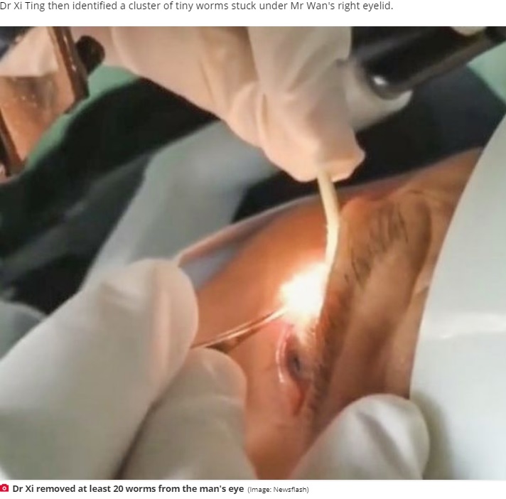 男性の目から寄生虫を取り出す医師（画像は『Daily Star　2020年10月26日付「Stomach-churning moment doctor removes 20 live worms from man’s eyelid」（Image: Newsflash）』のスクリーンショット）