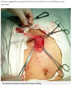 開腹手術の様子（画像は『Metro　2020年9月22日付「Toothbrush removed from man’s stomach after he swallowed it while brushing」（Picture: SWNS）』のスクリーンショット）