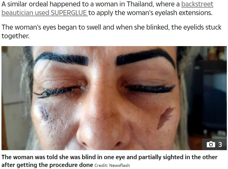 まつエクにより右目を失明した女性（画像は『The Sun　2020年10月3日付「BLINDED BY LASHES Woman left blind and scarred after glue from false eyelashes fell into her eye at beauty salon」（Credit: Newsflash）』のスクリーンショット）