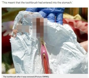 胃の中から取り出された血まみれの歯ブラシ（画像は『Metro　2020年9月22日付「Toothbrush removed from man’s stomach after he swallowed it while brushing」（Picture: SWNS）』のスクリーンショット）