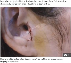 勝手に切除された耳珠（画像は『The Sun　2020年11月12日付「OH NOSE! Nose job patient shocked when surgeons cut off part of her ear - and now her headphones don’t fit」（Credit: Newsflash）』のスクリーンショット）