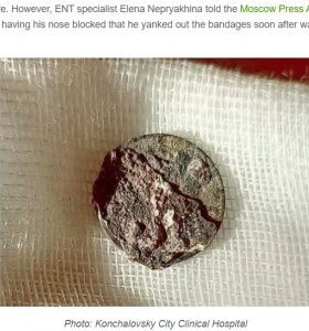 53年間も鼻の中に留まっていた硬貨（画像は『Oddity Central　2020年11月27日付「Kid Shoves Metal Coin Into His Nose, Forgets About It For 53 Years」（Photo: Konchalovsky City Clinical Hospital）』のスクリーンショット）