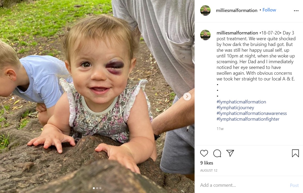 公園で遊ぶミリーちゃん（画像は『Millies Lymphatic Malformation　2020年8月12日付Instagram「18-07-20　Day 3 post treatment.」』のスクリーンショット）