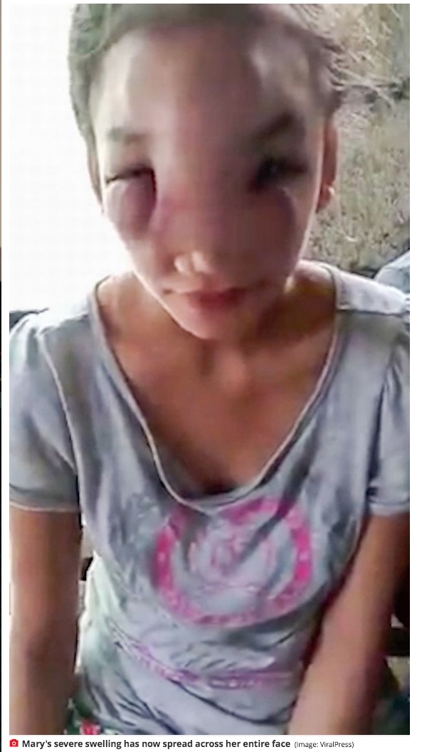 原因不明の顔の腫れで苦しむメリーさん（画像は『Mirror　2020年12月9日付「Girl, 17, blinded by mystery illness sparked from squeezing ‘harmless’ nose spot」（Image: ViralPress）』のスクリーンショット）