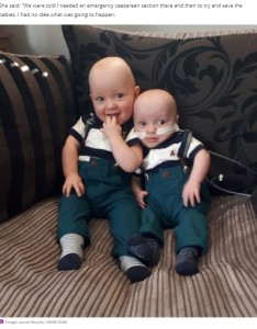 退院して自宅でポーズ（画像は『Birmingham Mail　2020年12月2日付「Twins born with a rare condition which makes one DOUBLE the size of the other」（Image: Lauren Murphy / SWNS.COM）』のスクリーンショット）