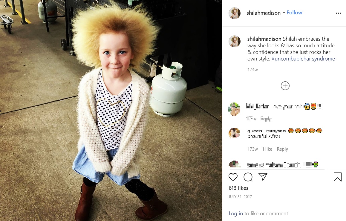 櫛でとかせない頭髪症候群の女児（画像は『Shilah Madison Calvert-Yin　2017年7月31日付Instagram「Shilah embraces the way she looks ＆ has so much attitude ＆ confidence that she just rocks her own style.」』のスクリーンショット）