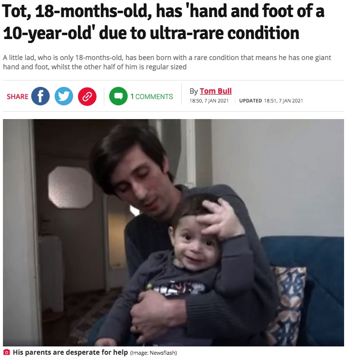 「クリッペル・トレノネー・ウェーバー症候群」を発症した男児（画像は『Daily Star　2021年1月7日付「Tot, 18-months-old, has ‘hand and foot of a 10-year-old’ due to ultra-rare condition」（Image: Newsflash）』のスクリーンショット）
