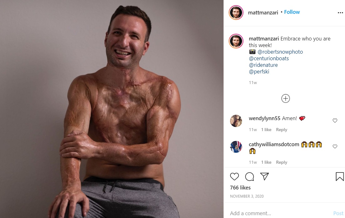 熱傷の痕が残るマットさん（画像は『Matt Manzari・Wolfwithin　2020年11月3日付Instagram「Embrace who you are this week!」』のスクリーンショット）