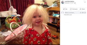 【海外発！Breaking News】「櫛でとかせない頭髪症候群」の女児　9歳になり髪に変化が（英）