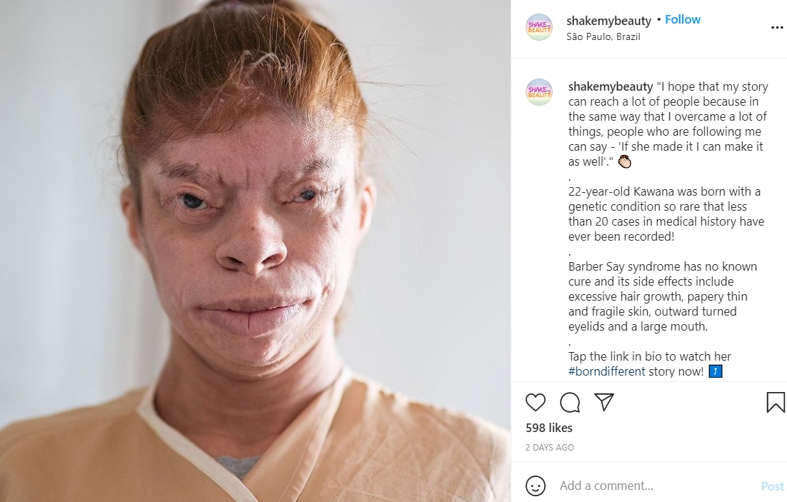 先天性遺伝子疾患「バーバー-セイ症候群」を患う女性（画像は『Shake My Beauty　2021年1月29日付Instagram「I hope that my story can reach a lot of people」』のスクリーンショット）