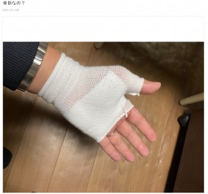 負傷した痛々しい左手（画像は『笠井信輔　2020年1月8日付オフィシャルブログ「骨折なの？」』のスクリーンショット）