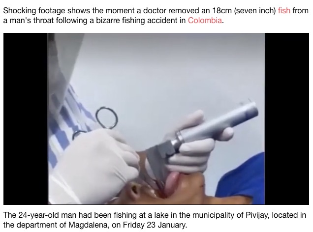 呼吸困難に陥った男性の喉から18センチの魚が！（画像は『LADbible　2021年1月31日付「Doctors In Colombia Remove 18cm Fish From Man’s Throat」』のスクリーンショット）