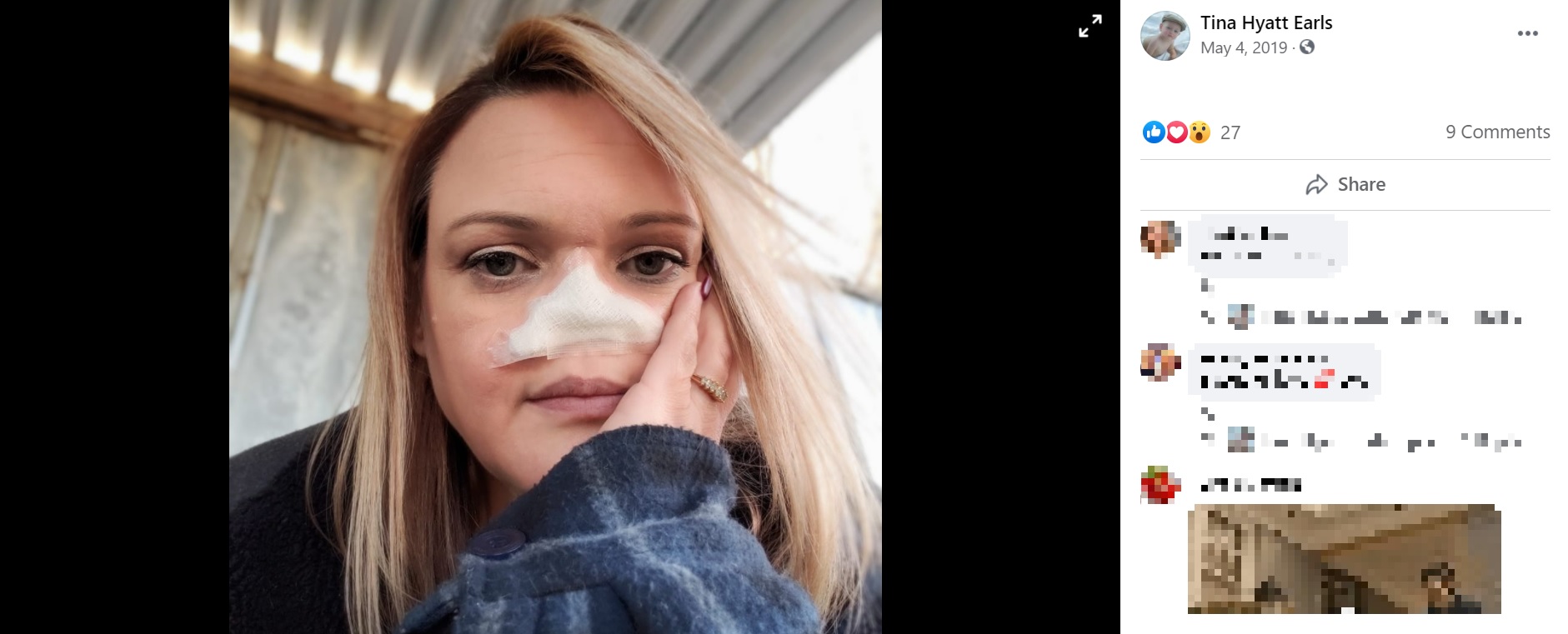 ガーゼで鼻を覆うティナさん（画像は『Tina Hyatt Earls　2019年5月4日付Facebook』のスクリーンショット）