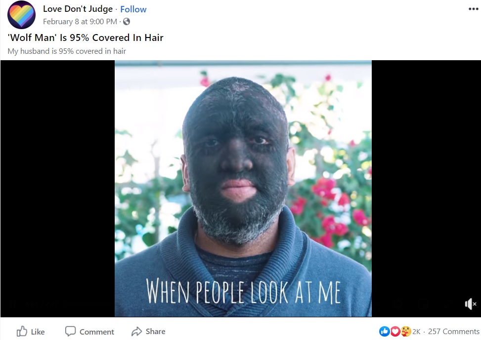 多毛症で「狼男」と呼ばれる男性（画像は『Love Don’t Judge　2021年2月8日付Facebook「‘Wolf Man’ Is 95％ Covered In Hair」』のスクリーンショット）