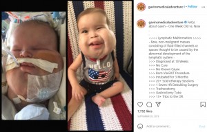 生後1週間（左）と1歳半過ぎのギャビン君（画像は『LM・W A R R I O R　2019年9月30日付Instagram「FAQs about Gavin」』のスクリーンショット）