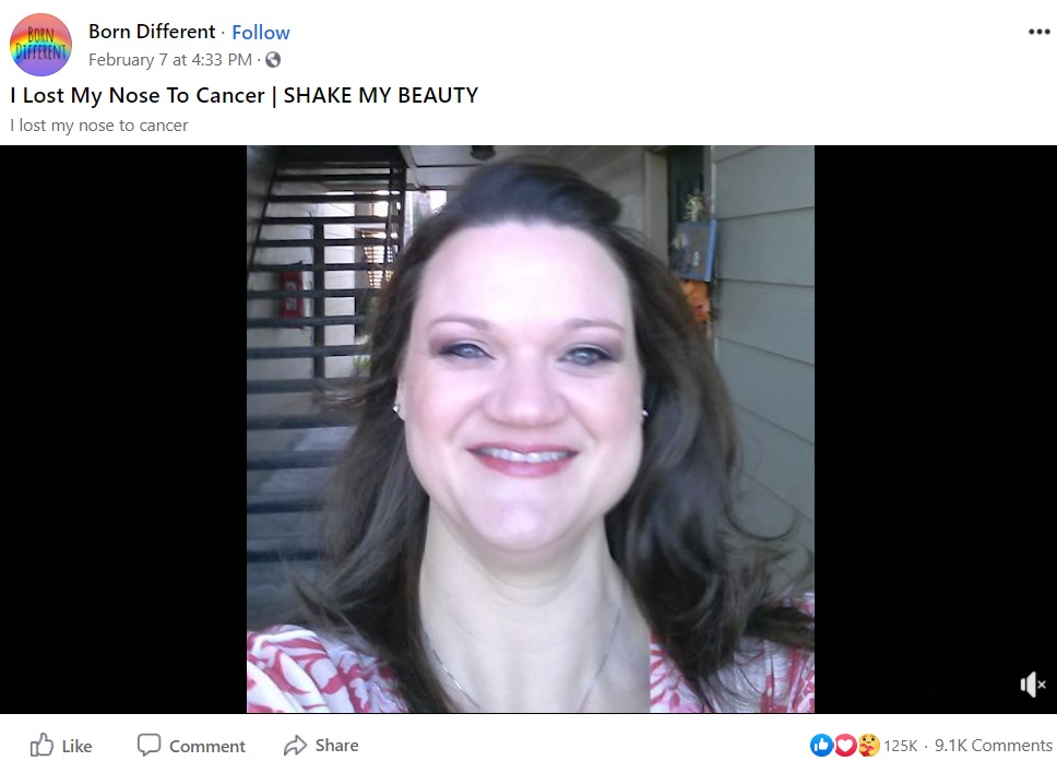 手術をする前の女性（画像は『Born Different　2021年2月7日付Facebook「I Lost My Nose To Cancer | SHAKE MY BEAUTY」』のスクリーンショット）