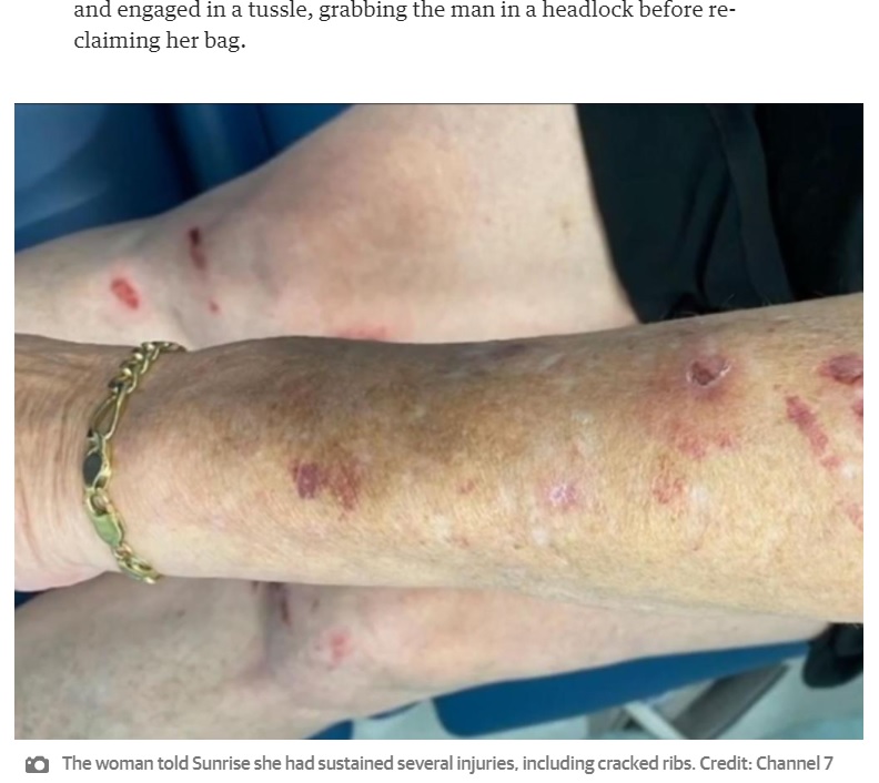腕や脚には多数の傷を負い、肋骨にはひびが入ってしまったという（画像は『PerthNow　2021年2月22日付「Dramatic footage shows Gold Coast grandma fight off alleged thief in carpark tussle」（Credit: Channel 7）』のスクリーンショット）