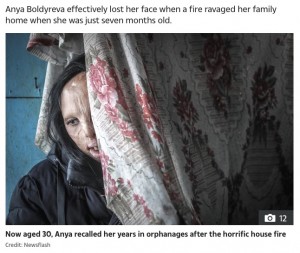 祖母によって見世物にされ生活費の足しにされた（画像は『The Sun　2021年3月24日付「TREATED LIKE A FREAK Woman who suffered horrific burns in house fire was put in ‘freak show display’ to raise cash for her gran」（Credit: Pavelvolkovphoto/Newsflash）』のスクリーンショット）