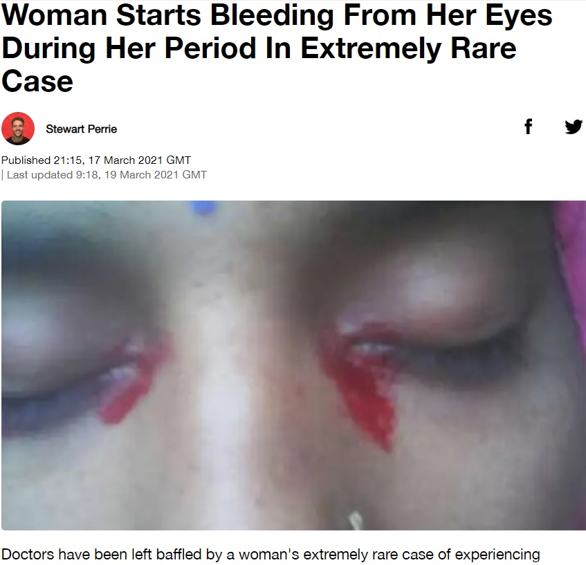 生理の時に血の涙が出るという女性（画像は『LADbible　2021年3月17日付「Woman Starts Bleeding From Her Eyes During Her Period In Extremely Rare Case」（Credit: BMJ）』のスクリーンショット）