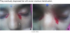 非常に珍しい代償性月経で、目から出血していた女性（画像は『LADbible　2021年3月17日付「Woman Starts Bleeding From Her Eyes During Her Period In Extremely Rare Case」（Credit: BMJ）』のスクリーンショット）
