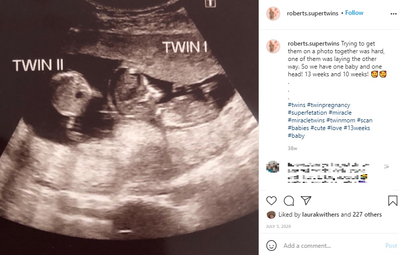 超音波検査で2人目の胎児が判明（画像は『Rare Special Twins　2020年7月5日付Instagram「Trying to get them on a photo together was hard」』のスクリーンショット）
