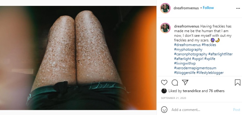 脚もこの通り（画像は『Andrea Ivonne Monroy　2020年9月21日付Instagram「Having freckles has made me be the human that I am now, 」』のスクリーンショット）