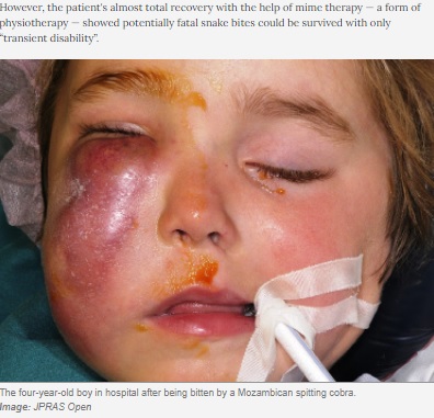 右目下をコブラに噛まれた男児（画像は『TimesLIVE　2021年5月22日付「Eina! Four-year-old recovers after cobra bites his face during SA holiday」（Image: JPRAS Open）』のスクリーンショット）