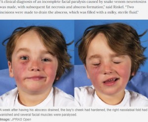 皮膚を切開後も患部の麻痺が続いた男児（画像は『TimesLIVE　2021年5月22日付「Eina! Four-year-old recovers after cobra bites his face during SA holiday」（Image: JPRAS Open）』のスクリーンショット）