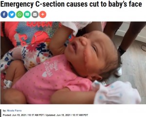 13針縫ったカヤーニちゃん（画像は『KRON4　2021年6月19日付「Emergency C-section causes cut to baby’s face」』のスクリーンショット）