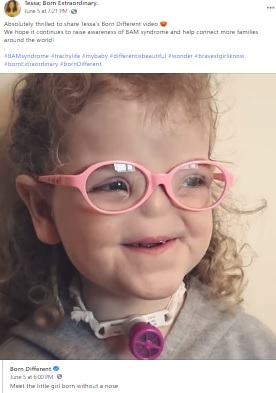 最初の人工鼻の手術を受けた後のテッサちゃん（画像は『Tessa; Born Extraordinary　2021年6月5日付Facebook「Absolutely thrilled to share Tessa’s Born Different video」』のスクリーンショット）