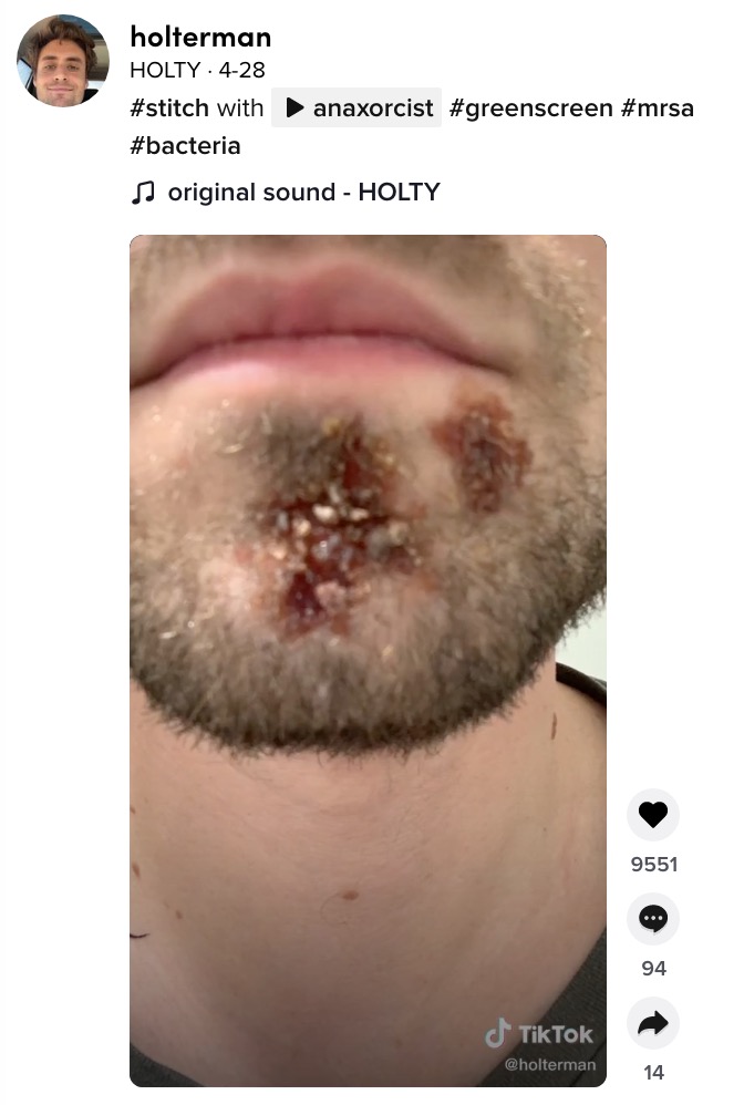 カミソリによって感染し化膿した顎（画像は『HOLTY　2021年4月28日付TikTok「＃stitch with anaxorcist」』のスクリーンショット）