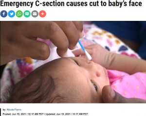 傷口の消毒をしてもらうカヤーニちゃん（画像は『KRON4　2021年6月19日付「Emergency C-section causes cut to baby’s face」』のスクリーンショット）