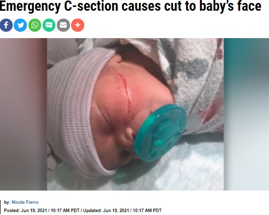 左頬の大きな傷が痛々しい（画像は『KRON4　2021年6月19日付「Emergency C-section causes cut to baby’s face」』のスクリーンショット）