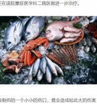 【海外発！Breaking News】魚に付着していた細菌が2ミリの傷から体内に　感染した20歳シェフが左腕を切断（中国）
