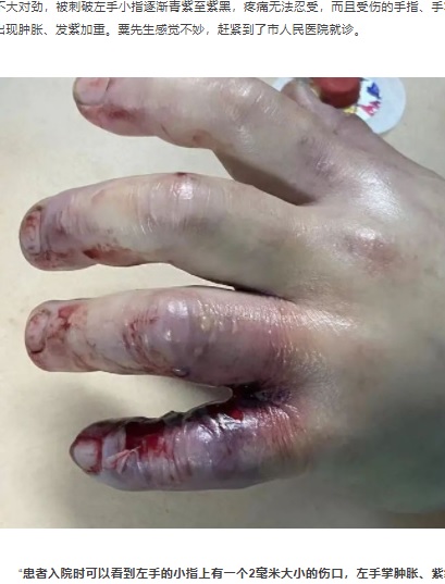 腫れあがり、変色した左手（画像は『网易　2021年5月23日付「危急丨临桂一厨师被海鱼扎伤手指，左臂被两次截肢保命...」（每日桂林）』のスクリーンショット）