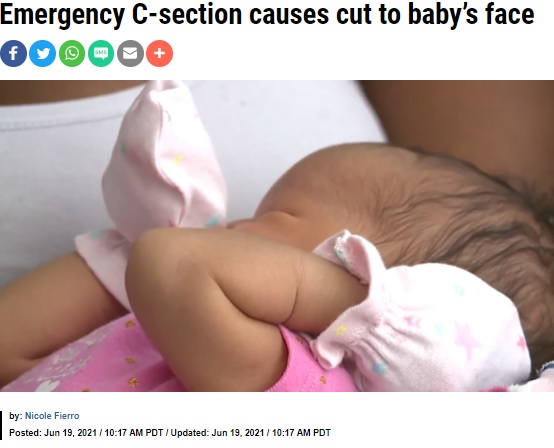 顔に傷を負い、引っ搔かないように手袋をする赤ちゃん（画像は『KRON4　2021年6月19日付「Emergency C-section causes cut to baby’s face」』のスクリーンショット）
