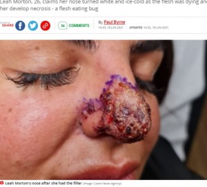 鼻が紫色に変色したリアさん（画像は『Mirror　2021年6月18日付「Woman almost loses nose and lip after catching flesh eating bug from botched filler」（Image: Caters News Agency）』のスクリーンショット）