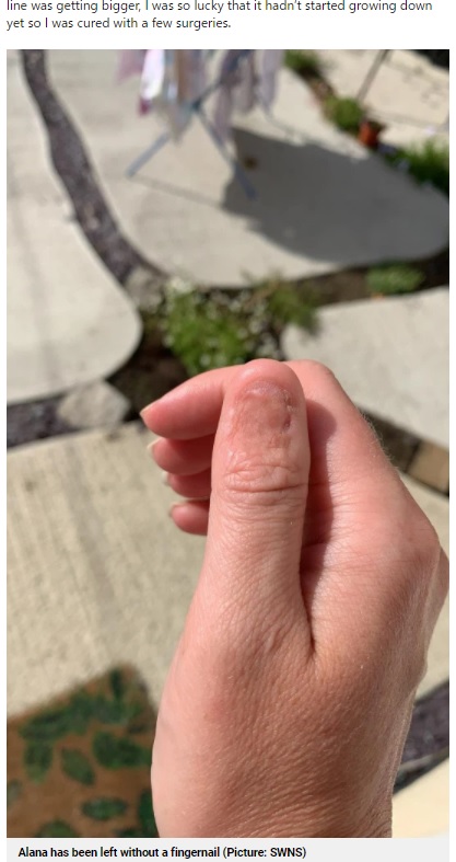 爪は無くなってしまったものの、数回の手術で済んだアラーナさんの親指（画像は『Metro　2021年6月27日付「Woman discovers line on her fingernail was a rare sign of cancer」（Picture: SWNS）』のスクリーンショット）