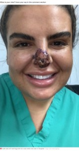 病院で1か月以上、毎日高気圧酸素療法を続けたリアさん（画像は『Mirror　2021年6月18日付「Woman almost loses nose and lip after catching flesh eating bug from botched filler」（Image: Caters News Agency）』のスクリーンショット）