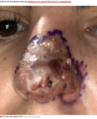 水膨れができて変色した鼻（画像は『Mirror　2021年6月18日付「Woman almost loses nose and lip after catching flesh eating bug from botched filler」（Image: Caters News Agency）』のスクリーンショット）