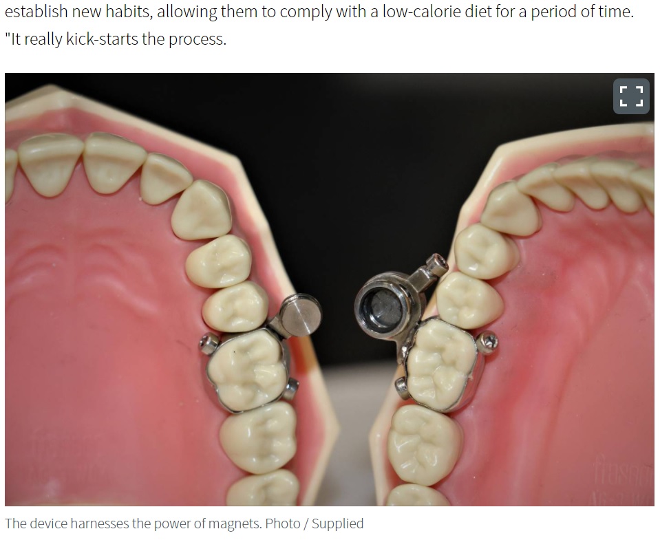 会話や呼吸は普通にできるというが…（画像は『NZ Herald　2021年6月28日付「DentalSlim Diet Control: Researcher defends weight-loss device after it sparks ridicule on social media」（Photo / Supplied）』のスクリーンショット）