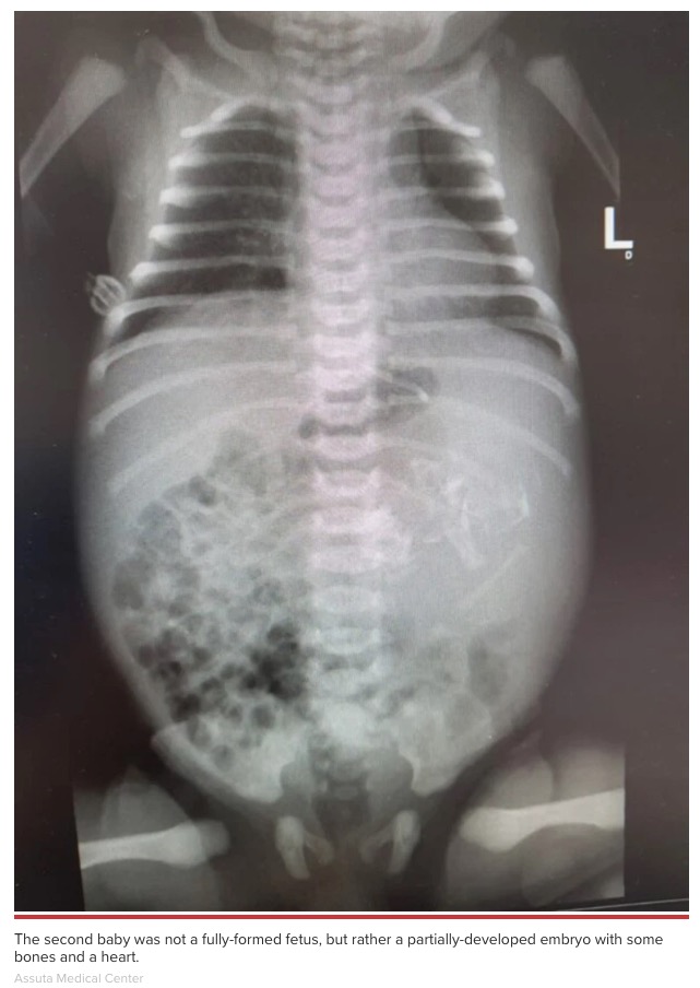 誕生した赤ちゃんのお腹には胎児が（画像は『New York Post　2021年7月29日付「Baby born with twin inside stomach in rare occurrence」（Assuta Medical Center）』のスクリーンショット）