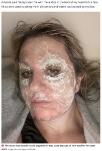最終的には満足のいく肌を手に入れることに（画像は『Mirror　2021年7月12日付「Woman ‘looked like Beetlejuice’ for a week after traumatic ￡1,800 face peel」（Image: Kennedy News and Media）』のスクリーンショット）