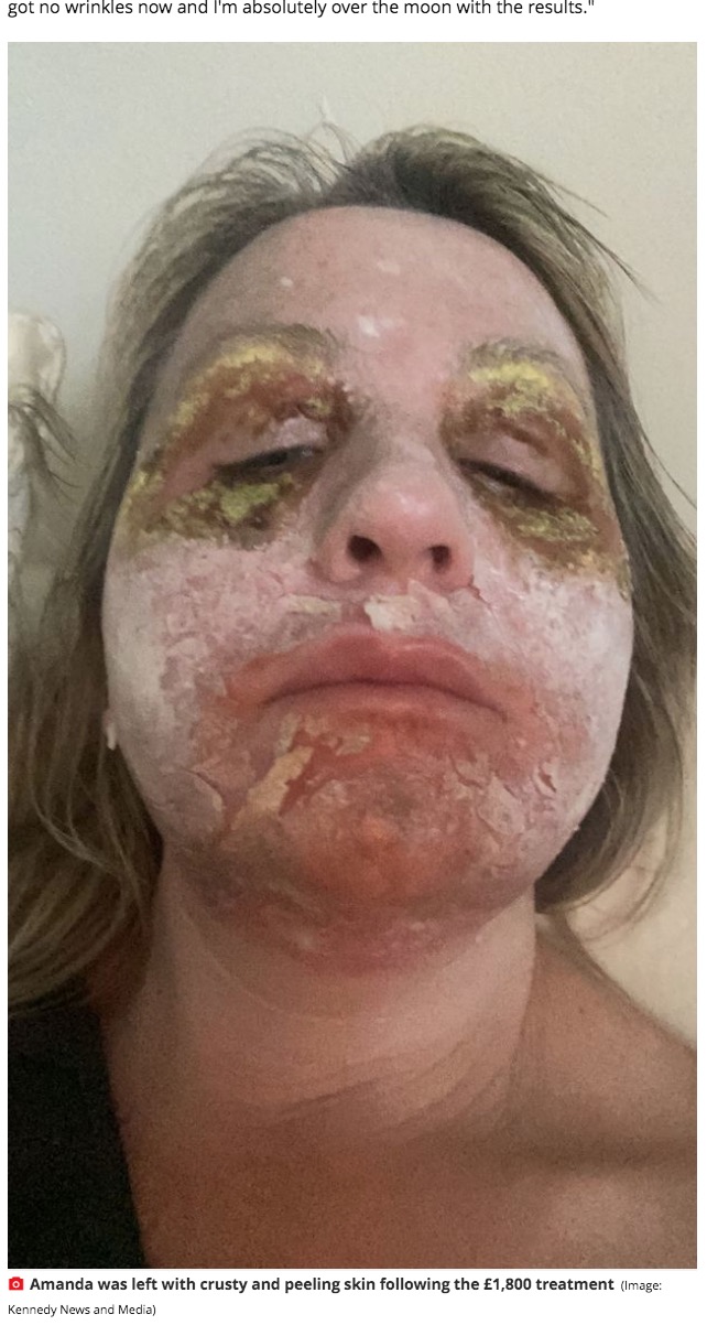 ホラーコメディ映画『ビートルジュース』のような顔に（画像は『Mirror　2021年7月12日付「Woman ‘looked like Beetlejuice’ for a week after traumatic ￡1,800 face peel」（Image: Kennedy News and Media）』のスクリーンショット）
