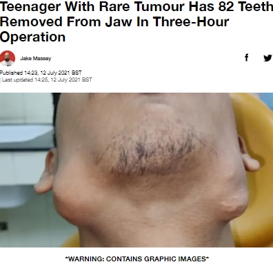 顔が変形し痛みで食事も摂れなかったというニティーシュさん（画像は『LADbible　2021年7月12日付「Teenager With Rare Tumour Has 82 Teeth Removed From Jaw In Three-Hour Operation」（Credit: Jam Press）』のスクリーンショット）