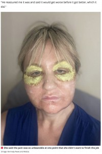「トラウマになる寸前だった」とアマンダさん（画像は『Mirror　2021年7月12日付「Woman ‘looked like Beetlejuice’ for a week after traumatic ￡1,800 face peel」（Image: Kennedy News and Media）』のスクリーンショット）