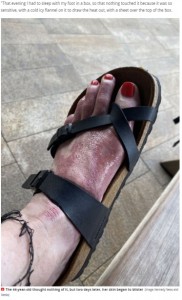 痛みで靴も履けなかったほど（画像は『Mirror　2021年7月5日付「Woman suffers horrific ‘margarita burns’ after spilling cocktail on foot」（Image: Kennedy News and Media）』のスクリーンショット）