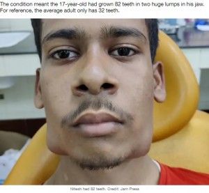 両顎部分が大きく腫れたニティーシュさん（画像は『LADbible　2021年7月12日付「Teenager With Rare Tumour Has 82 Teeth Removed From Jaw In Three-Hour Operation」（Credit: Jam Press）』のスクリーンショット）