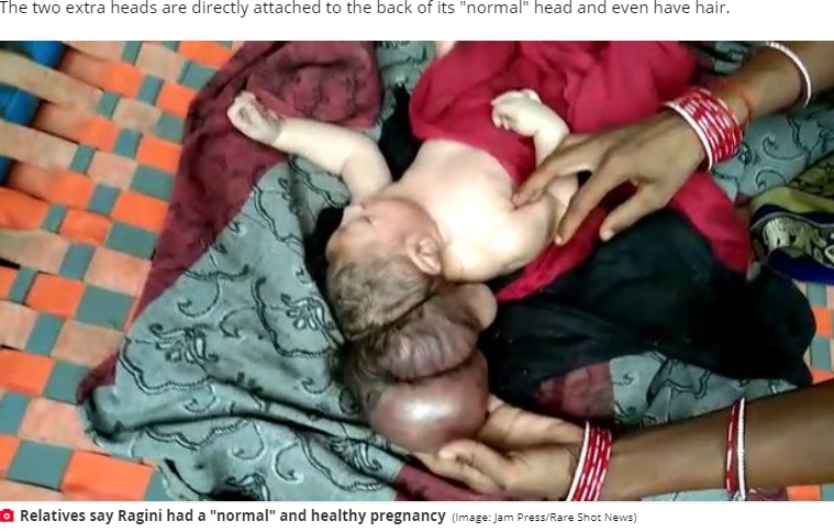 後頭部にお団子のように連なる頭（画像は『The Daily Star　2021年7月13日付「Three-headed baby hailed as incarnation of God after seemingly ‘normal’ pregnancy」（Image: Jam Press/Rare Shot News）』のスクリーンショット）